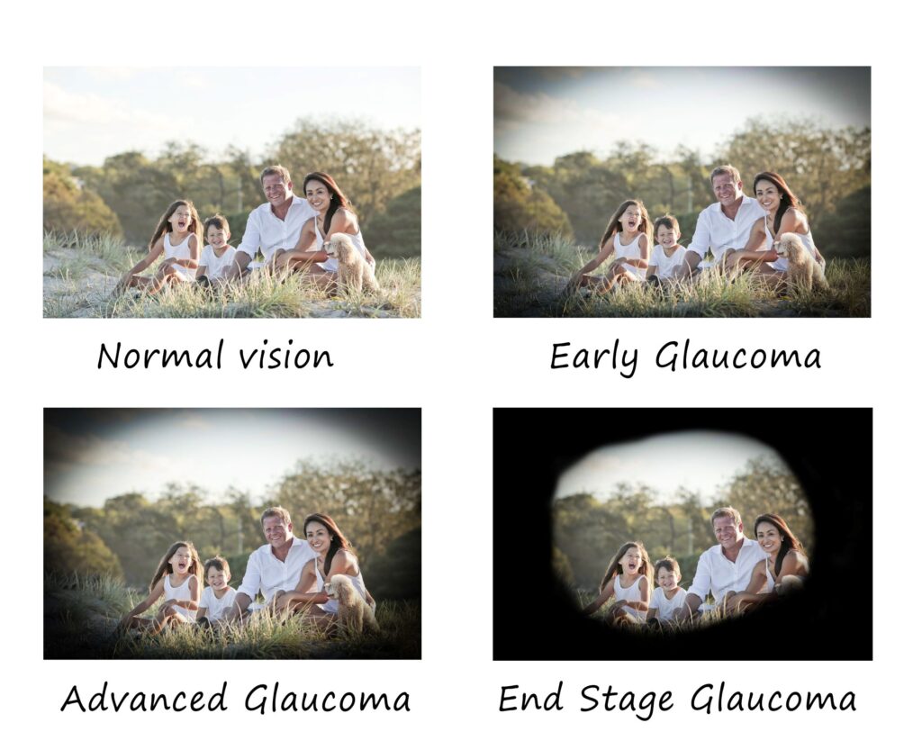 What does a low vision specialist do for glaucoma?